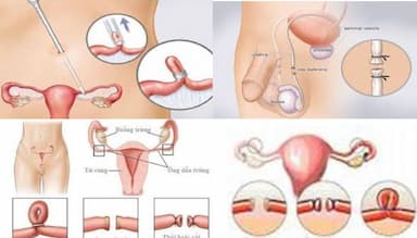 Triệt sản là gì? Ai nên áp dụng và có ảnh hưởng gì về sau không?